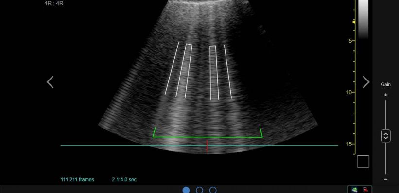 Point of Care Ultrasound Technology (POCUS) With AI