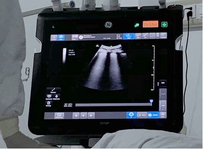 Point of Care Ultrasound Technology (POCUS) With AI